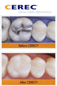 CEREC